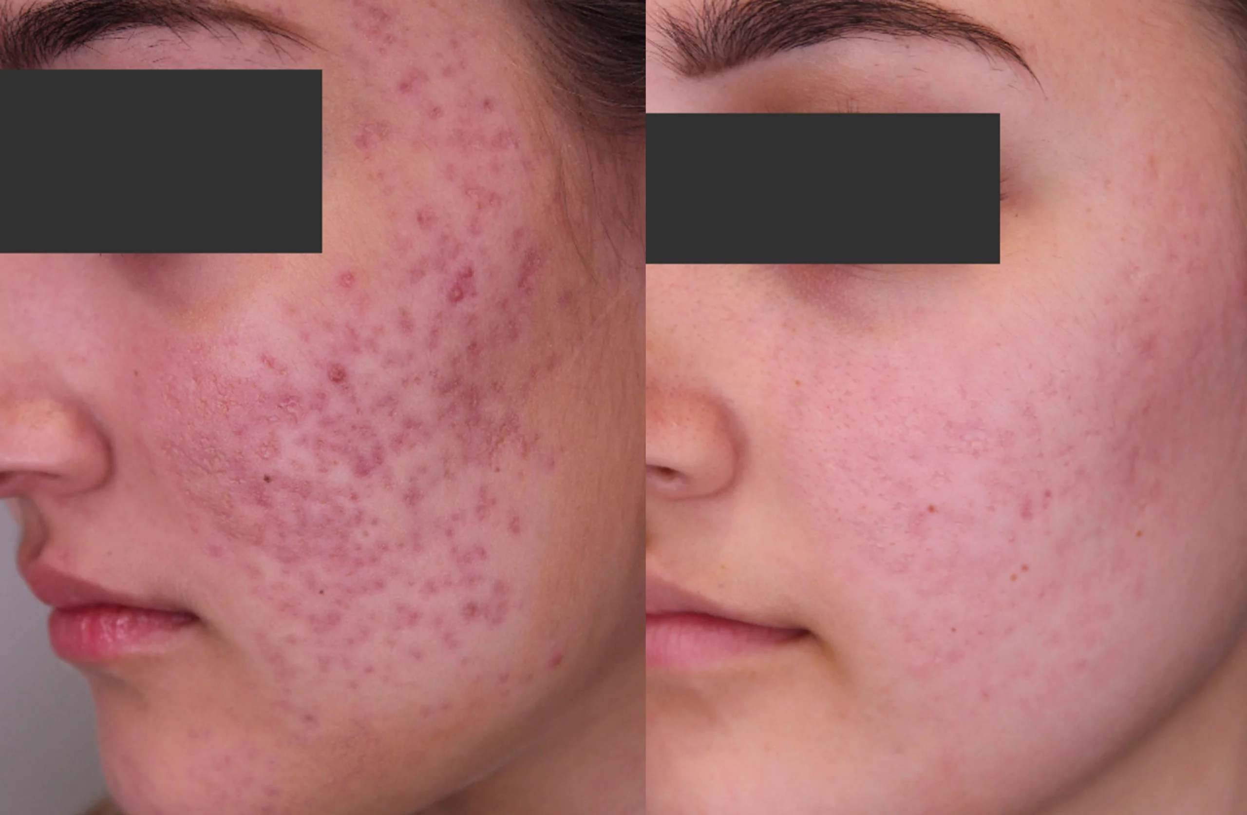 Acne scars treatment cutis dermatology brisbane 35 scaled