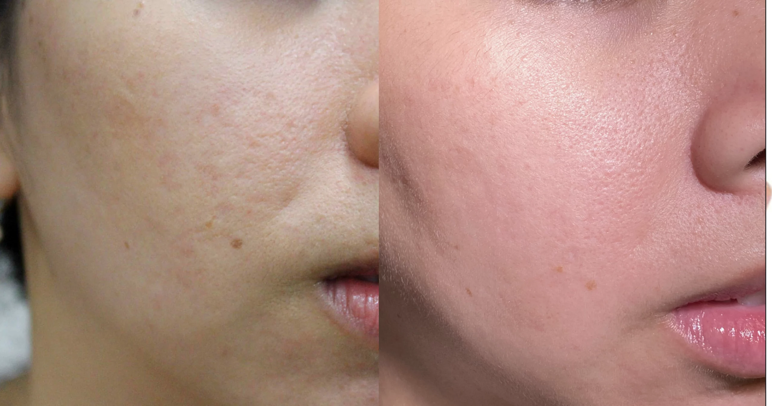 Acne scars treatment cutis dermatology brisbane 38 scaled