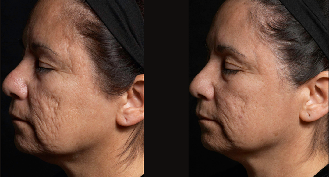 Acne scars treatment cutis dermatology brisbane 39