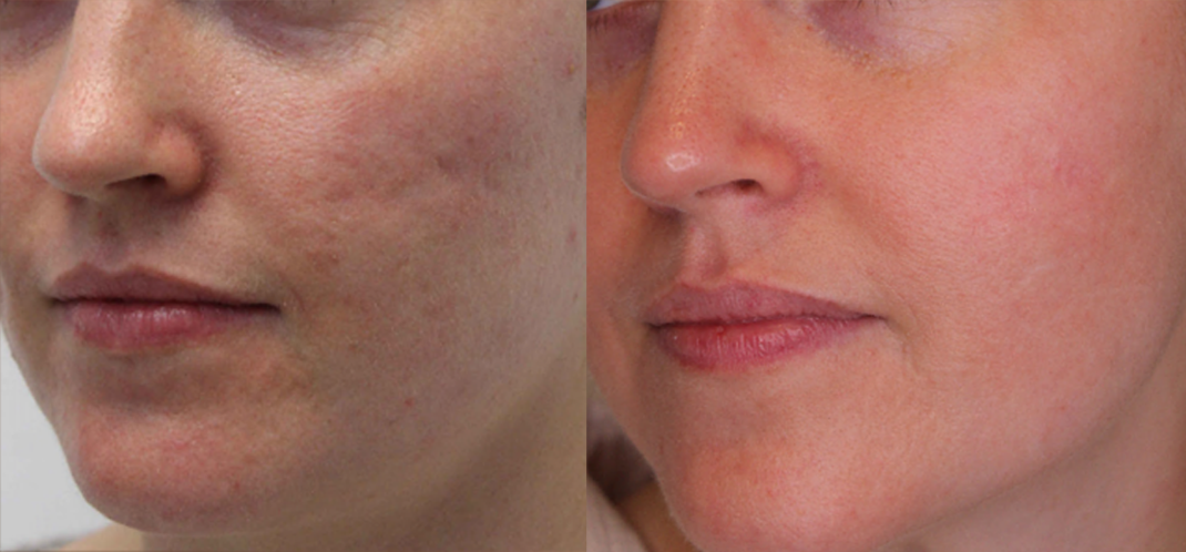 Acne scars treatment cutis dermatology brisbane 5