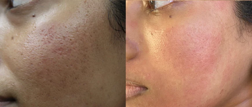 Acne scars treatment cutis dermatology brisbane 6