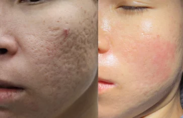 Acne scars treatment cutis dermatology brisbane 7