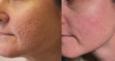 Acne scars treatment cutis dermatology brisbane 8