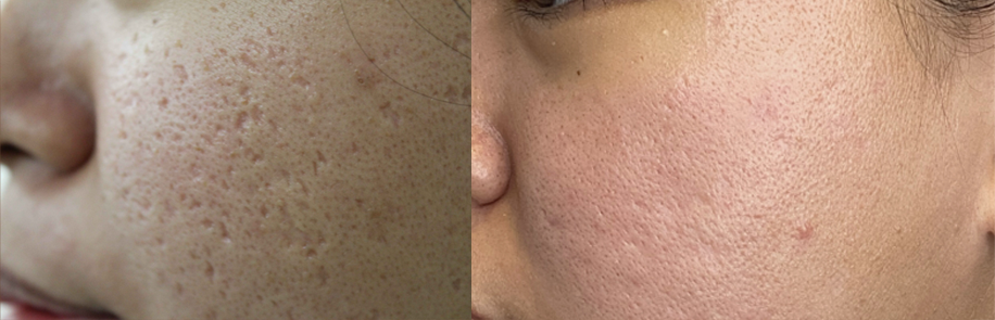 Acne scars treatment cutis dermatology brisbane 9