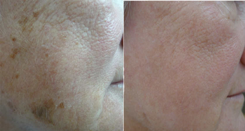 Age Spots Pigmentation 6