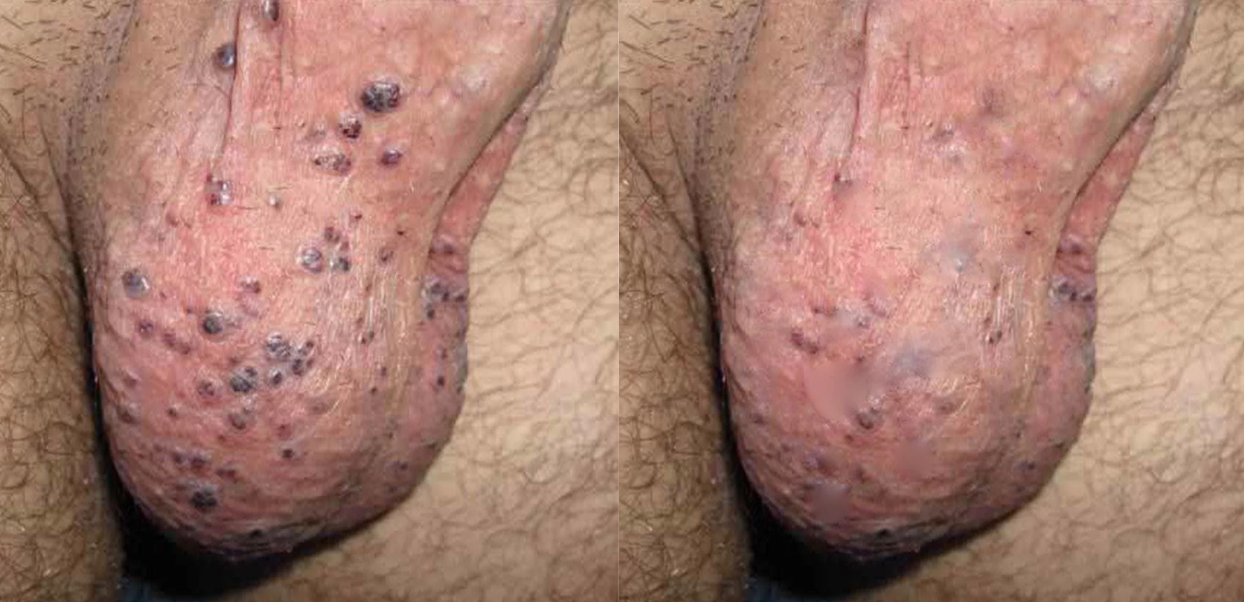Angiokeratoma of the scrotum multiple lesions cutis dermatology brisbane scaled
