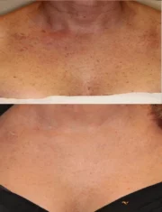 BBL Treatments treatment cutis dermatology brisbane 1