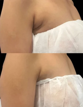 Body Treatment Cutis Dermatology Brisbane 9