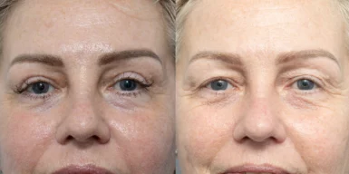 Co2 lasers treatment cutis dermatology brisbane scaled