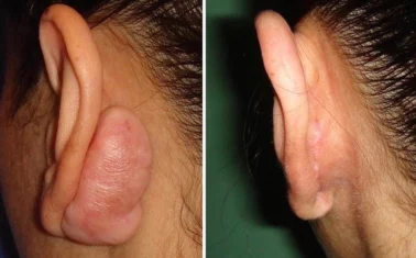Ear keloids treatment cutis dermatology brisbane 1 1