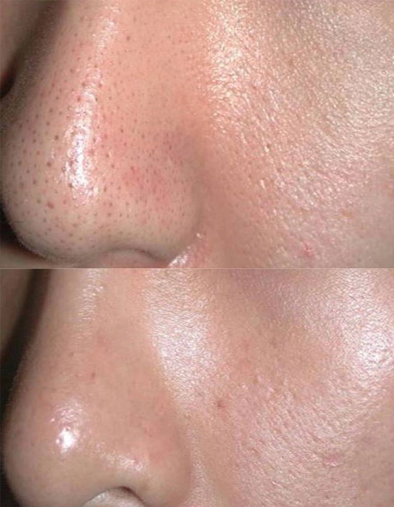 Enlarrged Pores Treatment Cutis Dermatology Brisbane 1