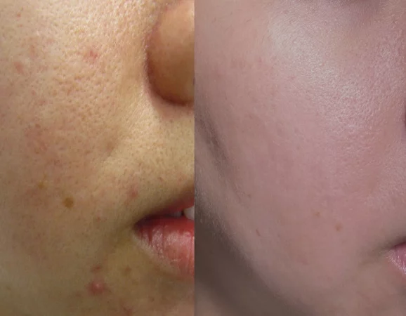 Enlarrged Pores Treatment Cutis Dermatology Brisbane 11