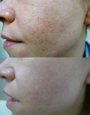 Enlarrged Pores Treatment Cutis Dermatology Brisbane 13