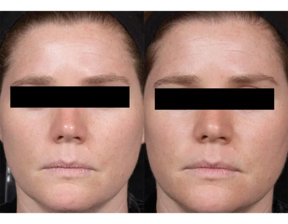 Enlarrged Pores Treatment Cutis Dermatology Brisbane 14