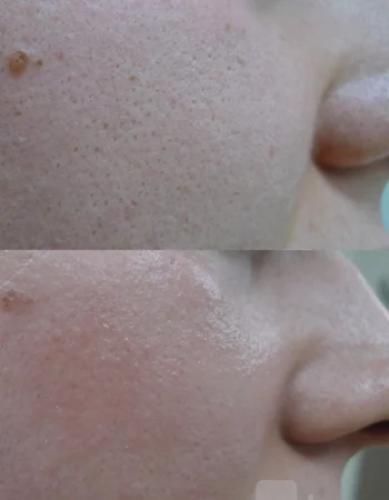Enlarrged Pores Treatment Cutis Dermatology Brisbane 16