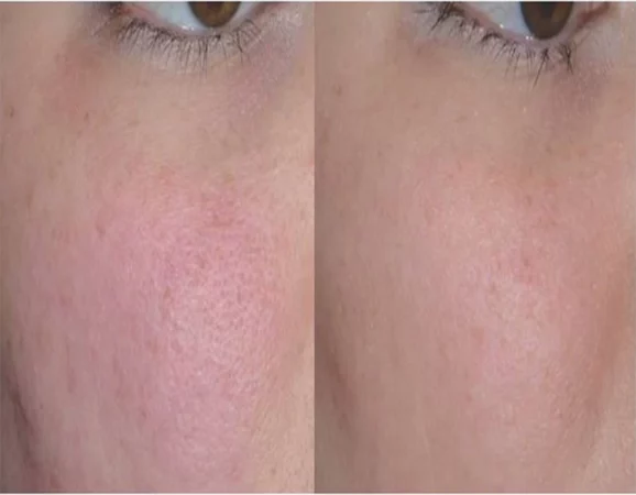 Enlarrged Pores Treatment Cutis Dermatology Brisbane 19