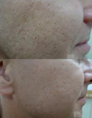 Enlarrged Pores Treatment Cutis Dermatology Brisbane 2