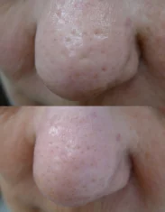 Enlarrged Pores Treatment Cutis Dermatology Brisbane 4