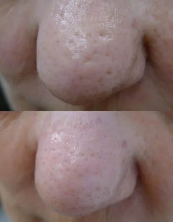 Enlarrged Pores Treatment Cutis Dermatology Brisbane 4