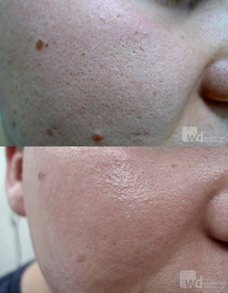Enlarrged Pores Treatment Cutis Dermatology Brisbane 5