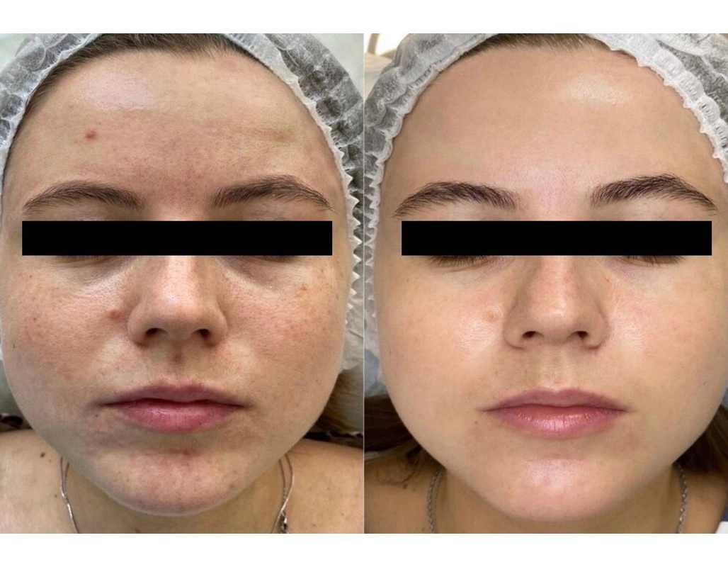 Enlarrged Pores Treatment Cutis Dermatology Brisbane 6