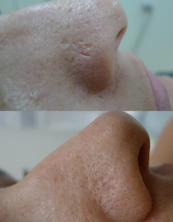 Enlarrged Pores Treatment Cutis Dermatology Brisbane 8