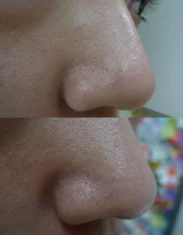 Enlarrged Pores Treatment Cutis Dermatology Brisbane 9