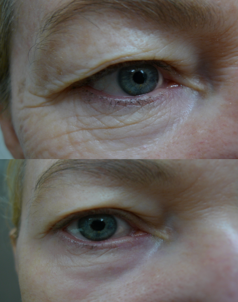 Eye wrinkle crem treatment cutis dermatology brisbane