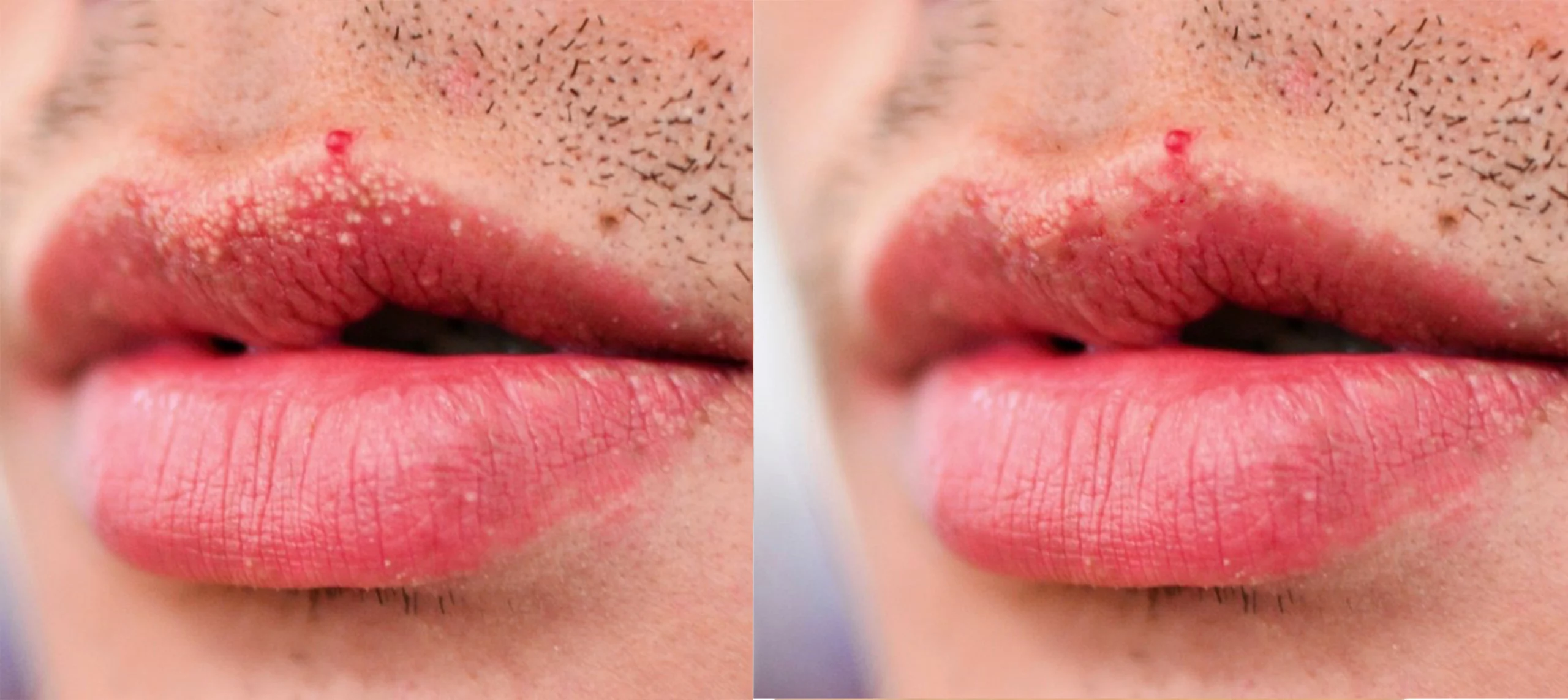 Fordyce spots lip cutis dermatology brisbane scaled