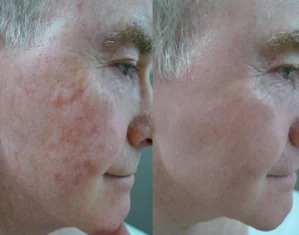 Fractional lasers treatment cutis dermatology brisbane 1