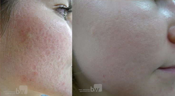 Fraxel gold coast acne scars treatment cutis dermatology brisbane e1655811045914