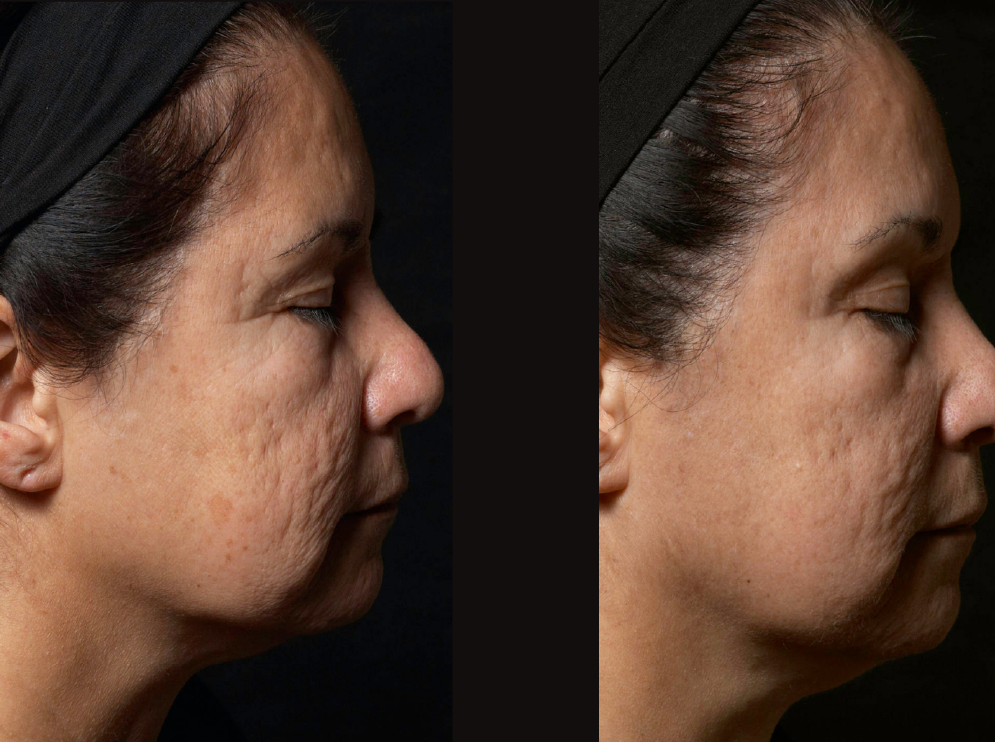 Fraxel laser for acne scars treatment cutis dermatology brisbane 2