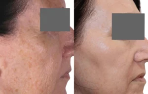 Fraxel treatment Cutis Clinic brisbane