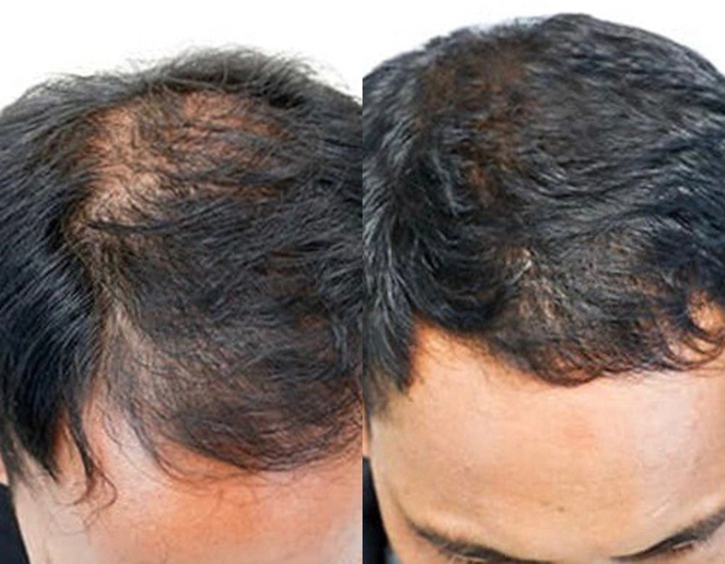 Growth Factor Injections for hair loss - Cutis Dermatology