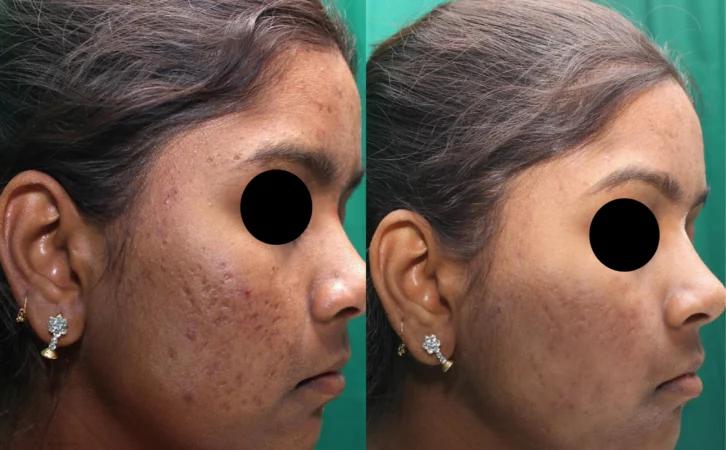 INFINI acne scars treatment cutis dermatology brisbane scaled