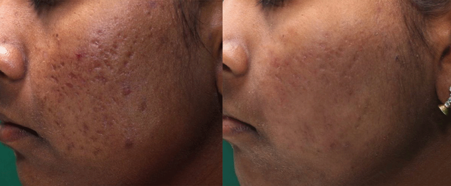 Infini scar treatment cutis dermatology brisbane