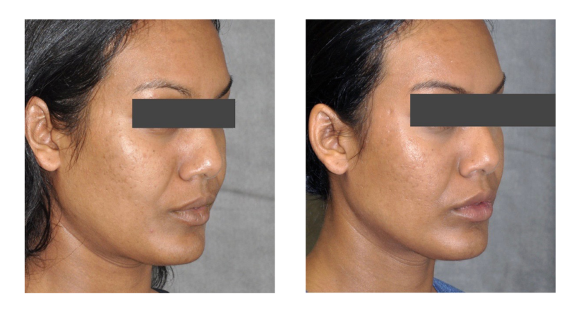 Jowl treatment 1