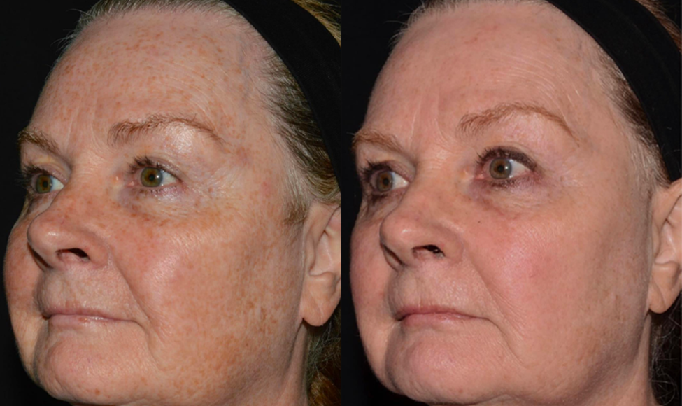 Laser Resurfacing treatment cutis dermatology brisbane 20