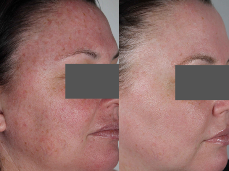 Laser Resurfacing treatment cutis dermatology brisbane 23