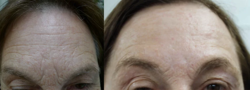 Laser Resurfacing treatment cutis dermatology brisbane 24