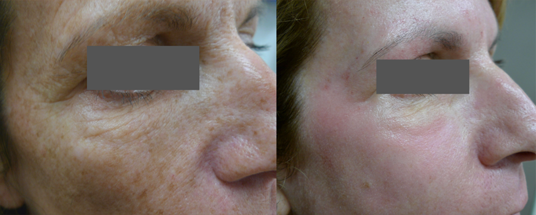 Laser Resurfacing treatment cutis dermatology brisbane 26