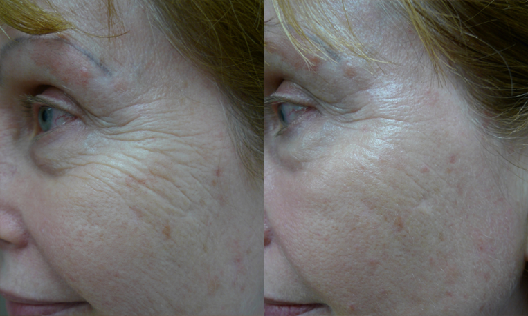 Laser Resurfacing treatment cutis dermatology brisbane 29