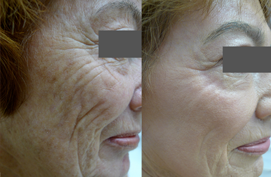 Laser Resurfacing treatment cutis dermatology brisbane 30