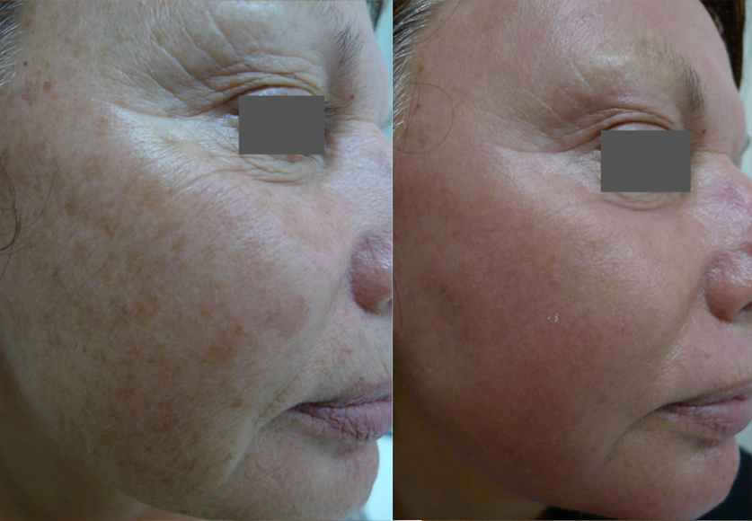 Laser Resurfacing treatment cutis dermatology brisbane 34