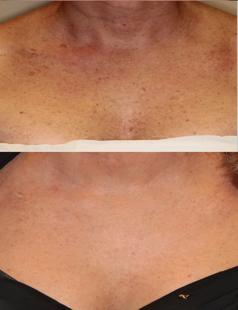 Laser Resurfacing treatment cutis dermatology brisbane 35