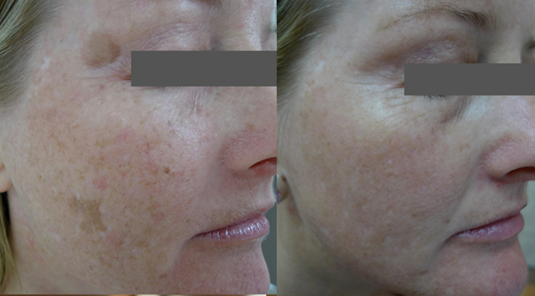 Laser Resurfacing treatment cutis dermatology brisbane 37