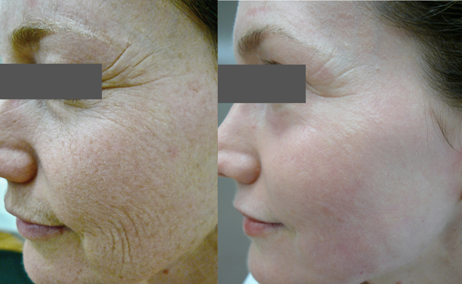 Laser Resurfacing treatment cutis dermatology brisbane 42