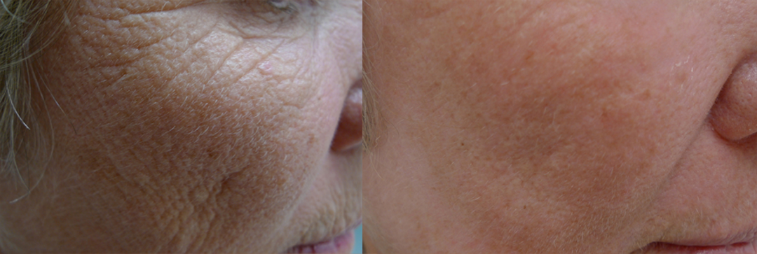 Laser Resurfacing treatment cutis dermatology brisbane 44
