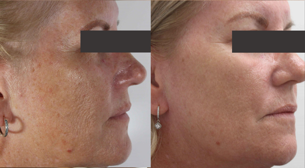 Laser Resurfacing treatment cutis dermatology brisbane 50