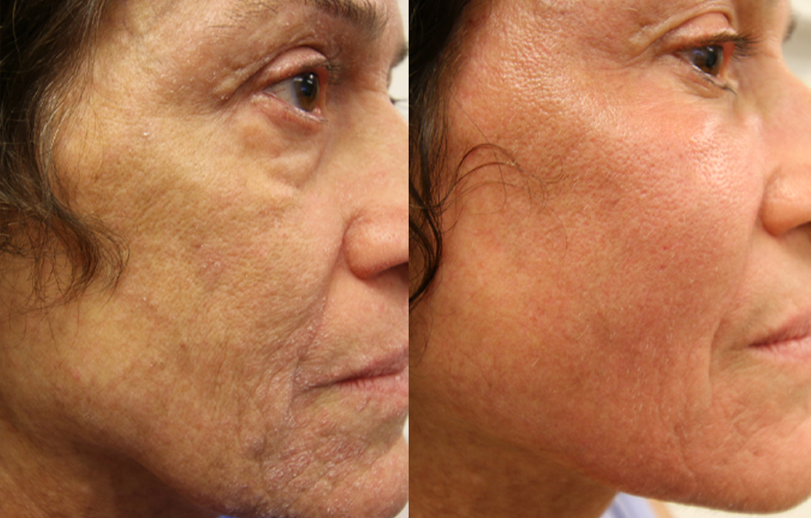 Laser Resurfacing treatment cutis dermatology brisbane 60